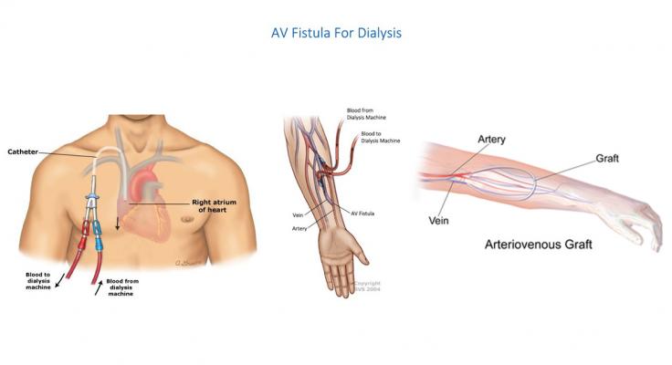 AV Fistula for Dialysis