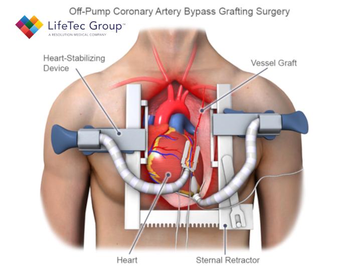 Open-chest coronary bypass procedure is very invasive