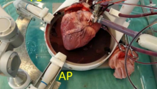 Cardiac ultrasound